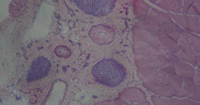 TRIANKLE project will develop 3D bioprinted personalised scaffolds for tissue regeneration of ankle joint TRIANKLE project will develop 3D bioprinted personalised scaffolds for tissue regeneration of ankle joint